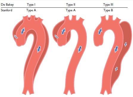 Classification of aortic dissection