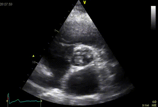 2D-image of a tricuspid aortic valve (TTE).